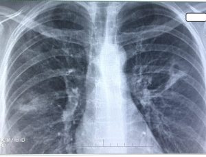 radiografie pulmonară cu tuberculoză